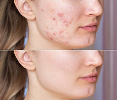 Anti-Acne Treatment