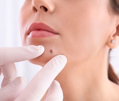 Beauty Spot Creation