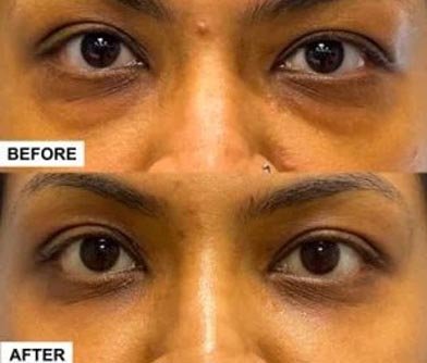 Blepharoplasty