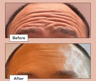 Botox Treatment