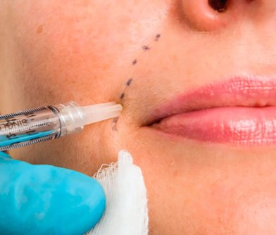 Dermal Filler