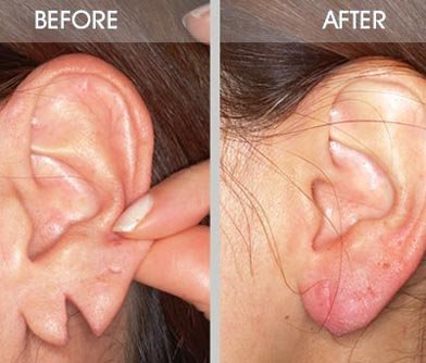 Ear Lobe Repair