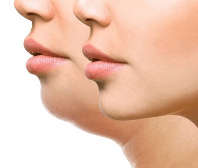 Fat Lysis Injections