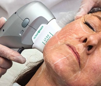 HIFU Face Lift