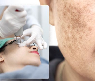 Laser Depigmentation