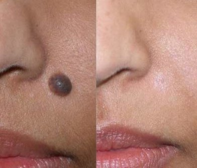 Laser Mole Removal