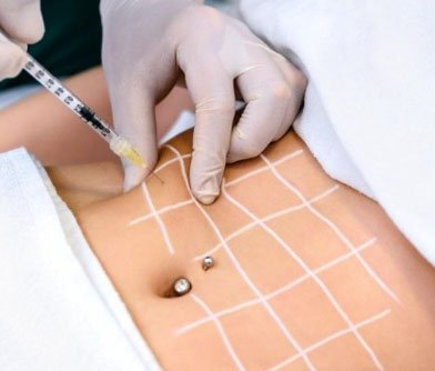 Non-Surgical Fat Reduction