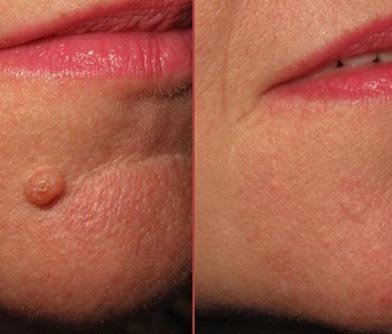 Sebaceous Cyst Removal
