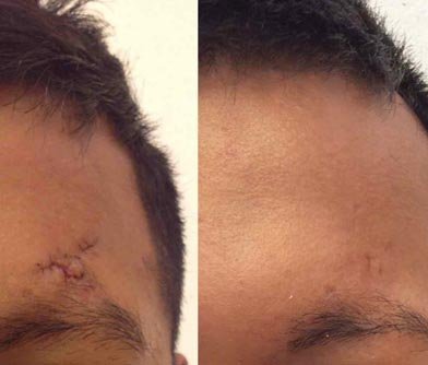 Surgical Scar Revision