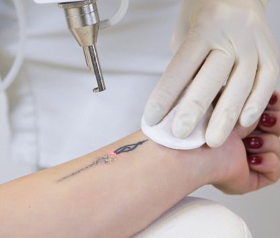 Tattoo Removal