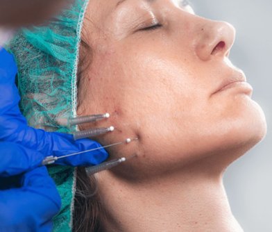 Threadlift