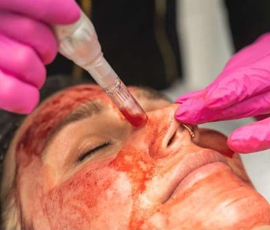 Vampire Facial